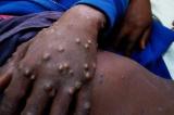 L'épidémie de Monkey pox s'étend en RDC, prévient l'OMS