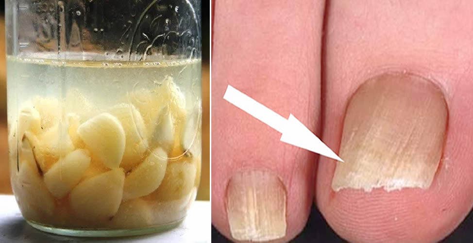 7 remèdes pour lutter contre les mycoses des ongles - Améliore ta Santé