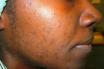 Infos congo - Actualités Congo - -Quelles solutions pour limiter les rougeurs et imperfections liées à l’acné ?