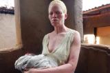 Malawi : les Albinos témoignent : 