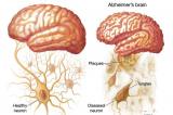 Maladie d’Alzheimer : bientôt un nouveau vaccin ?