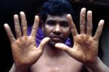 Au Bangladesh, l’arsenic empoisonne toujours les habitants