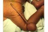 Patient bizarre : un bébé humain né avec une véritable queue