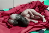 En Inde, ce bébé est né avec trois têtes