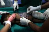 Brésil: de la peau de Tilapia pour soigner les brûlures