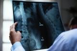 Les pilules anti contraceptifs exposent les femmes au cancer du sein (Clinique Kinoise)