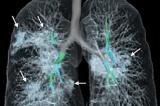 De nouvelles images montrent les dégâts du coronavirus sur les poumons