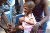 Tshopo : plus de 11 000 enfants malnutris répertoriés en six mois