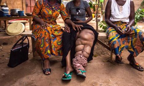 Infos congo - Actualités Congo - -Vers la distribution des médicaments contre la filariose au Kasaï oriental et Lomami