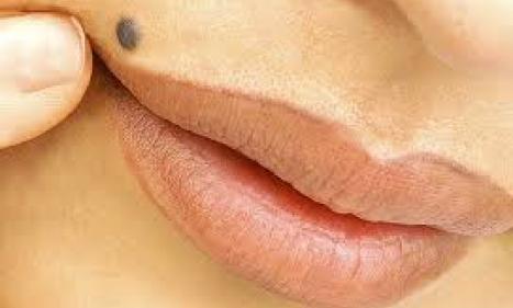 Infos congo - Actualités Congo - -Vers un traitement des grains de beauté géants pour éviter la chirurgie