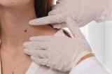 Cancer de la peau : comment savoir si un grain de beauté est un mélanome ?