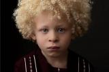 Devenir mannequin a changé la vie de ce petit garçon albinos