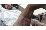 Son iPhone explose dans sa poche : il est brûlé au troisième degré