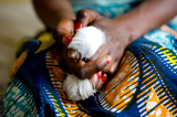 Tanganyika : plus de 140 cas de lèpre notifiés en 2025 dans la zone de santé de Moba