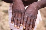 Maniema : 7 zones de santé touchées par l’épidémie de Monkeypox avec plus de 500 cas