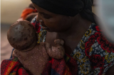 Mpox : 43 décès enregistrés sur 1 090 cas à Tshopo depuis le début de l’année