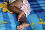Kasaï : 16 cas d'épidémie Monkeypox confirmés dans quatre zones de santé   