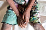 Sud-Kivu : 350 cas de Mpox enregistrés en une semaine