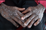 Epidémie de Mpox : les premiers vaccins attendus avec impatience