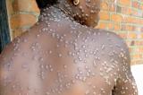 Mpox : la RDC prévient la population face à cette épidémie devenue un problème de santé publique
