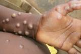 RDC/Mpox : 56 nouveaux cas confirmés à la 46ème semaine épidémiologique