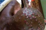 Kongo-Central : près de 10 cas de Mpox suspects détectés à Kisantu