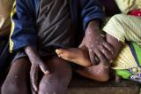 Haut-Uele : un premier cas suspect de Monkey Pox signalé à Faradje