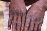 Madagascar : le nombre de cas confirmés de mpox s'alourdit à 78