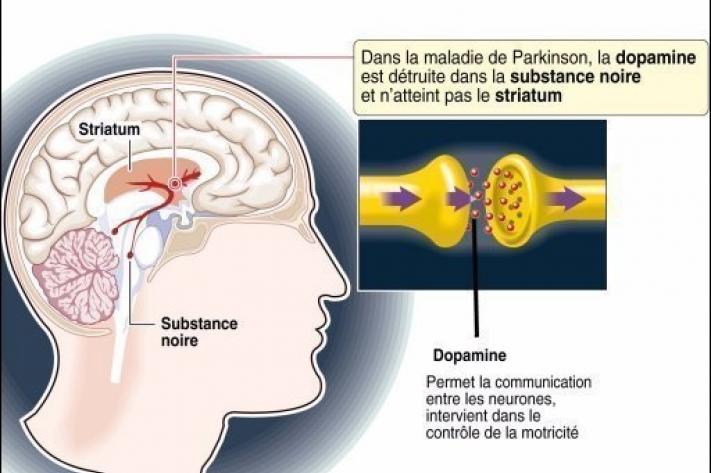 La maladie de Parkinson, une ancienne pathologie mal connue du public