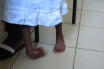 Infos congo - Actualités Congo - -Maniema : 87 enfants guéris de la malformation de pied bot en 2023