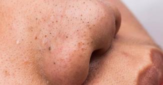 Infos congo - Actualités Congo - -3 remèdes bénéfiques pour en finir avec les points noirs