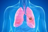 Avons-nous trouvé un nouveau moyen de stopper le cancer du poumon ?