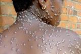Tshopo : 23 cas de Mpox confirmés parmi les détenus de la prison centrale de Kisangani