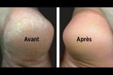 Trois solutions naturels contre les pieds rugueux et secs