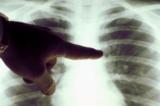 Kwilu : 14.787 maladies tuberculeux détectés en 2022 sur toute l'étendue de la province