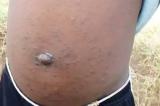 Haut-Uele : la société civile de Niangara alerte sur une maladie très contagieuse semblable à la varicelle
