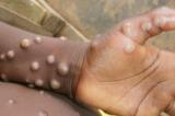 Texas : un passager venant du Nigeria positif à la variole du singe