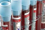 VIH/Sida : une thérapie par anticorps donne des résultats encourageants