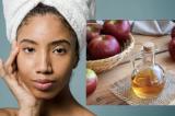 Le vinaigre de cidre : un allie naturel pour réduire les boutons et les imperfections